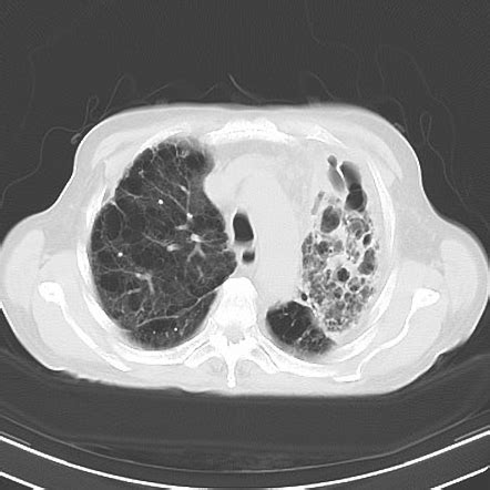 copf|Combined Pulmonary Fibrosis and Emphysema